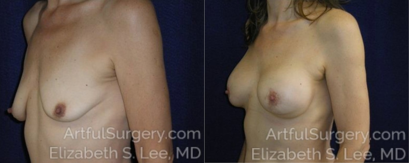 Picture of Breast Lift-14a
