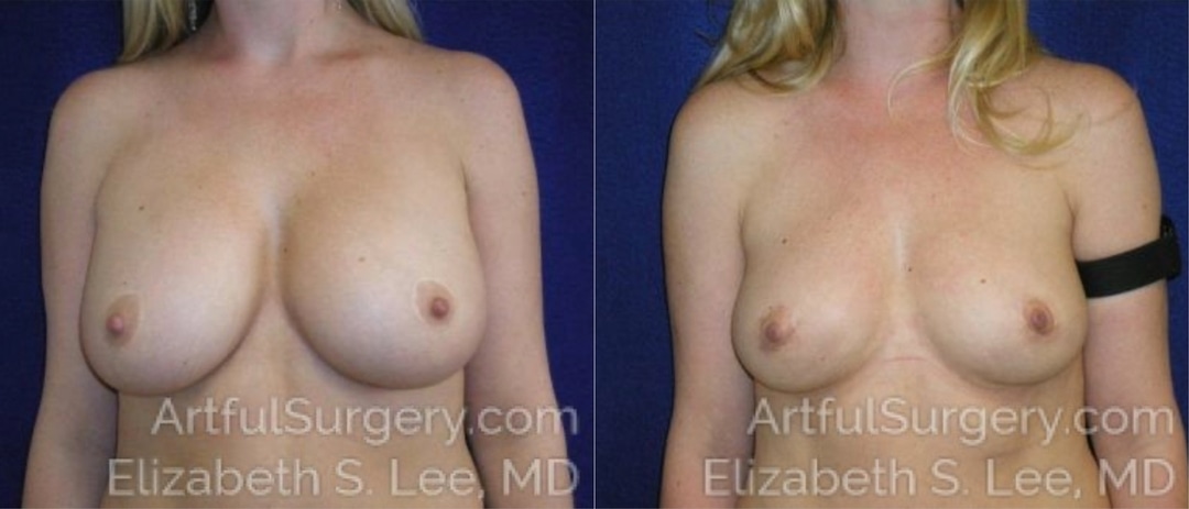 Picture of Breast Lift-15