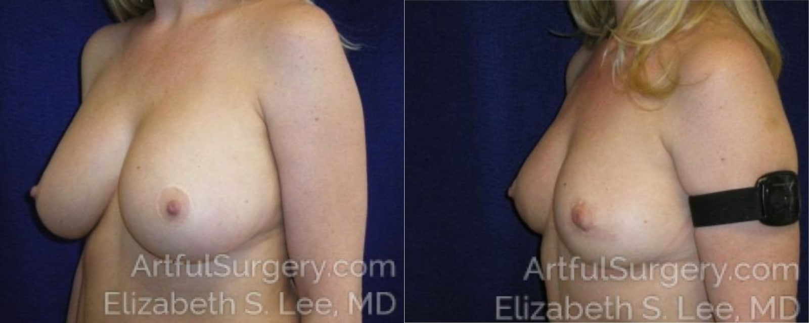Picture of Breast Lift-15a