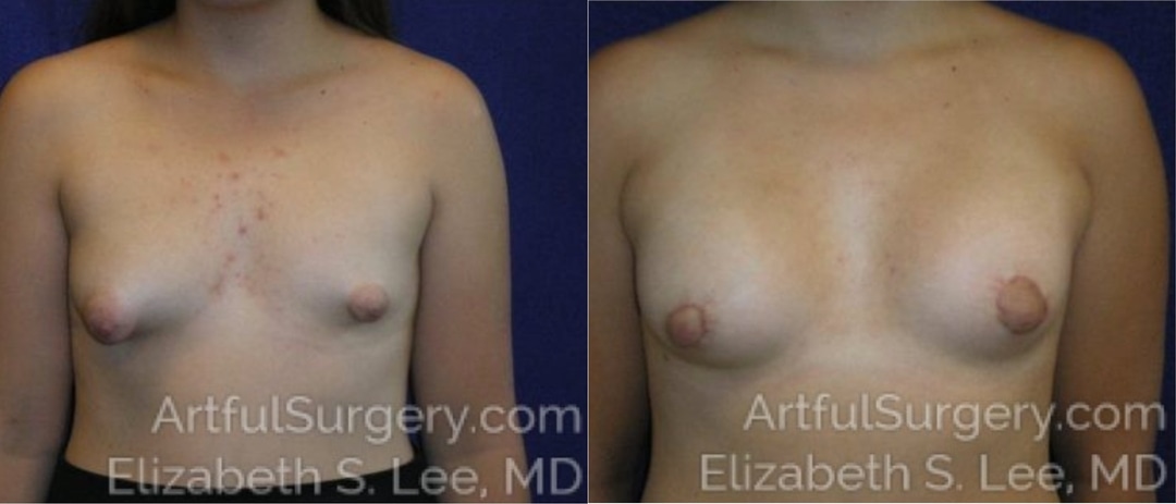 Picture of Breast Lift-16