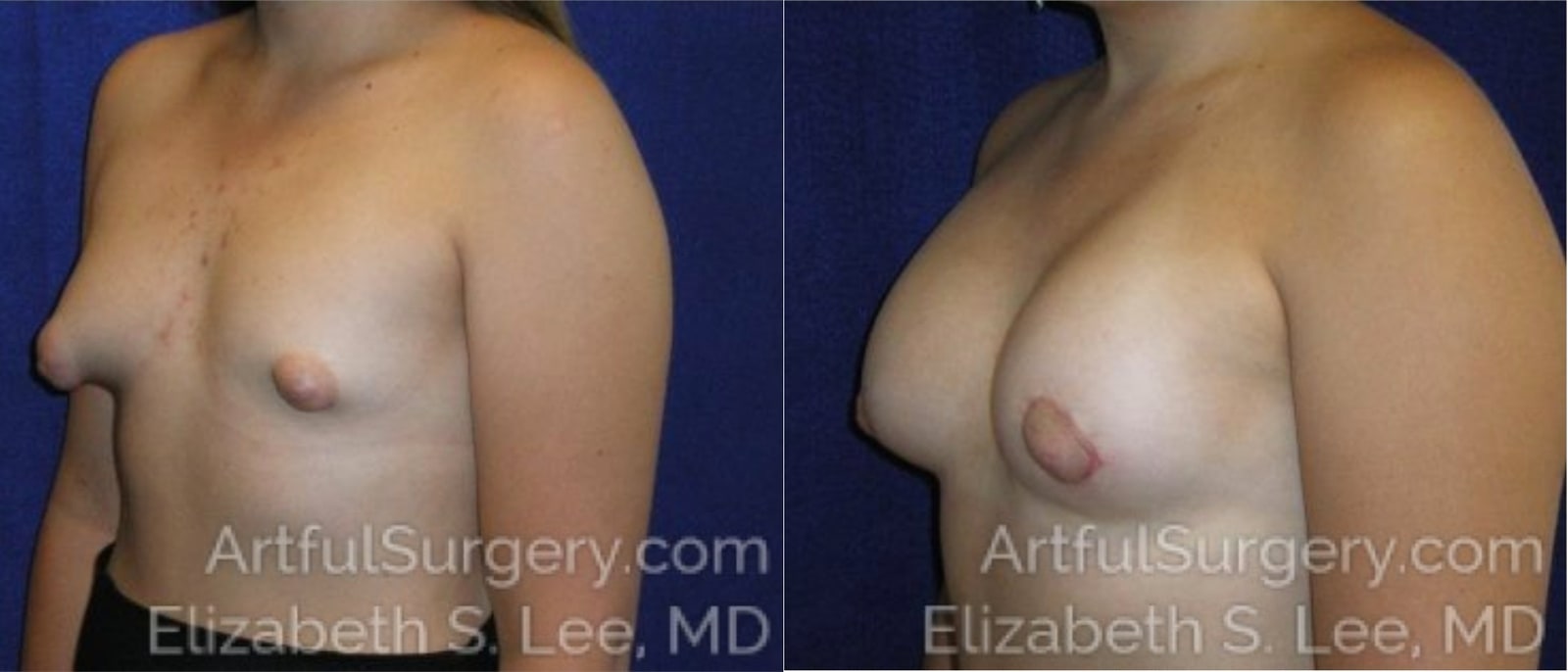 Picture of Breast Lift-16a