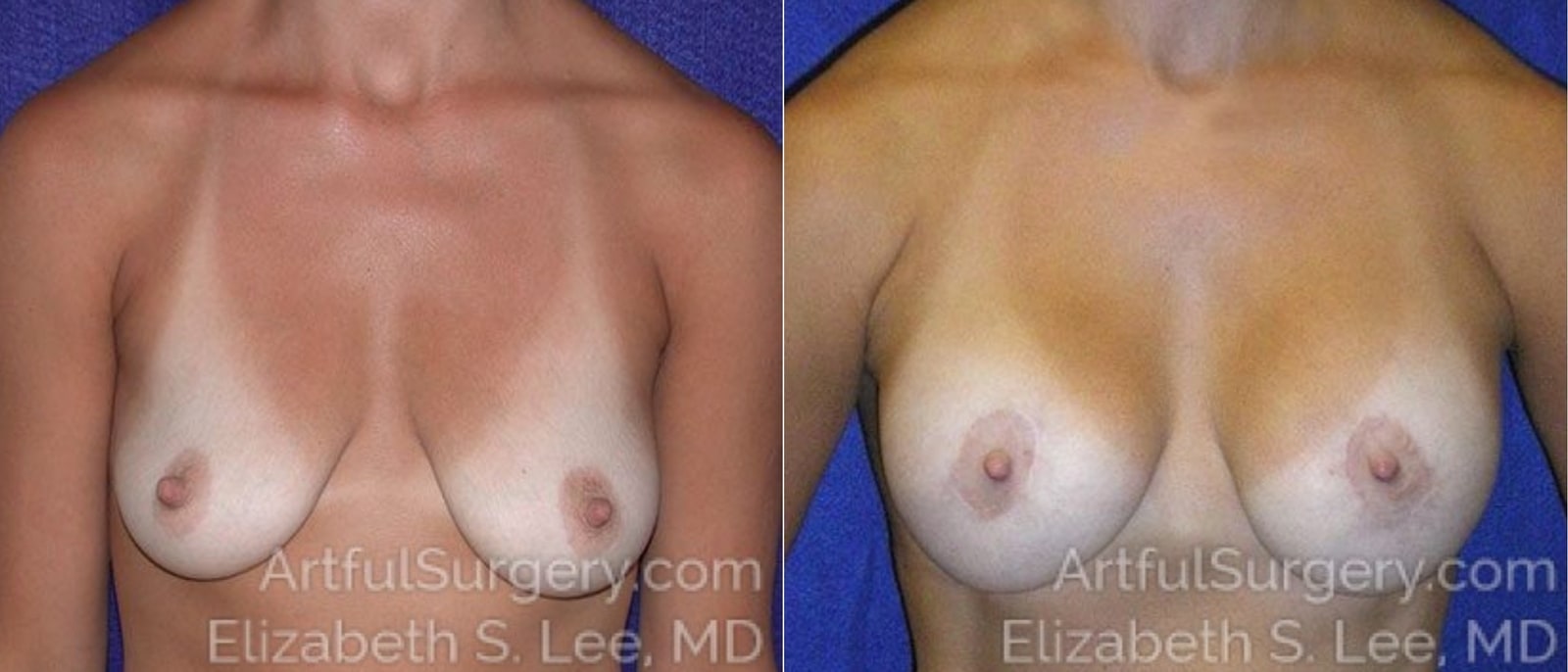 Picture of Breast Lift-17