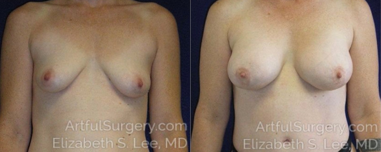 Picture of Breast Lift-18