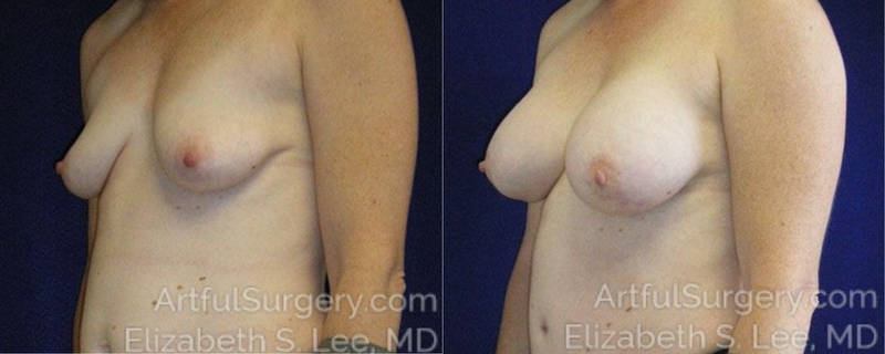 Picture of Breast Lift-18a
