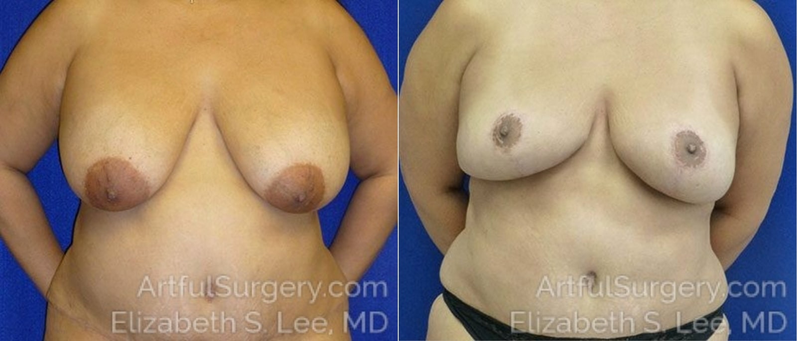 Picture of Breast Lift-19