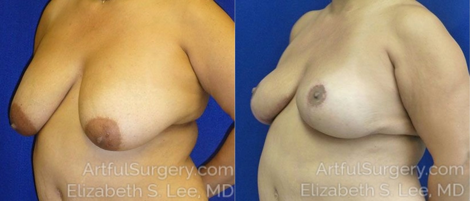 Picture of Breast Lift-19a