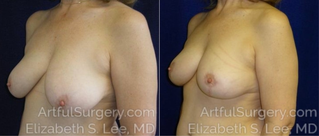 Picture of Breast Lift-1a