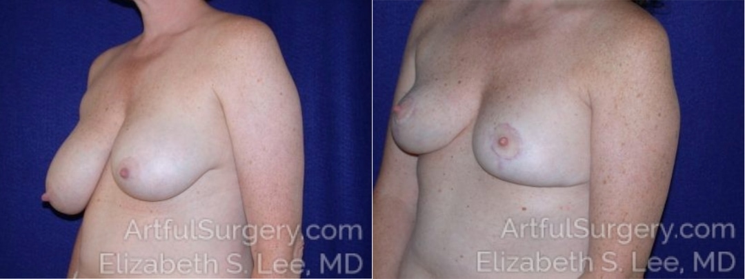 Picture of Breast Lift-2