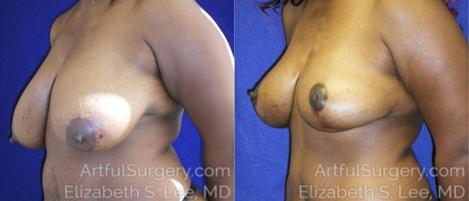 Picture of Breast Lift-20a