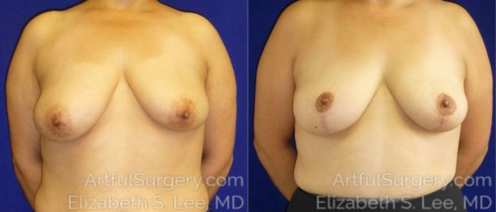 Picture of Breast Lift-21