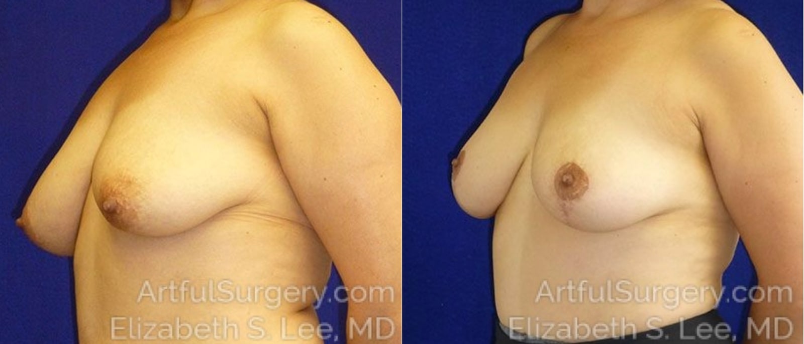 Picture of Breast Lift-21a
