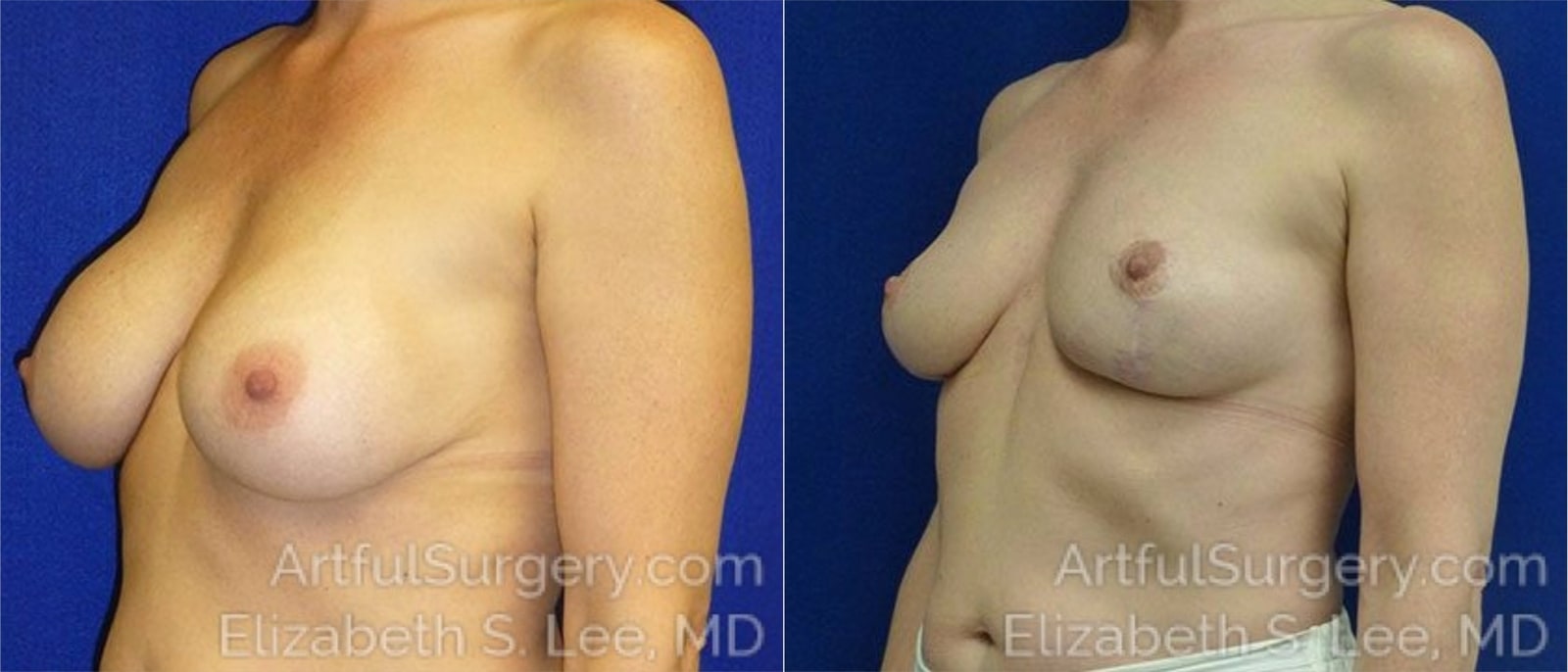 Picture of Breast Lift-22a
