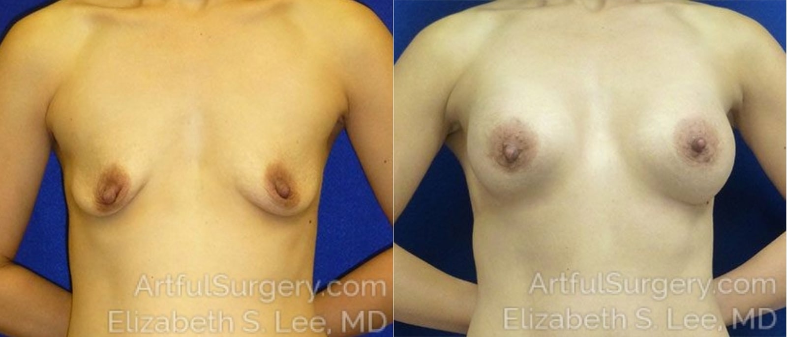 Picture of Breast Lift-23
