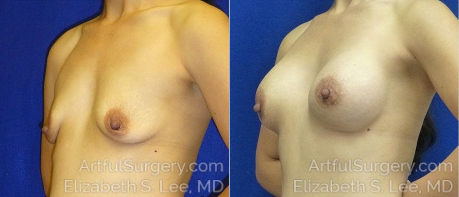Picture of Breast Lift-23a