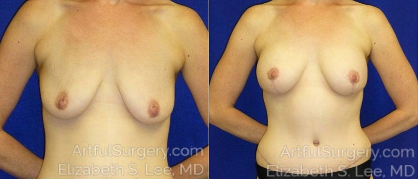 Picture of Breast Lift-24