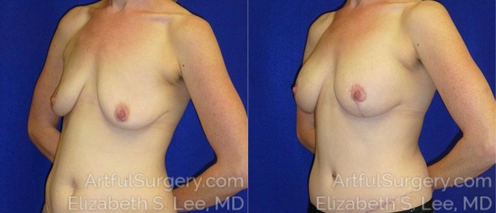 Picture of Breast Lift-24a