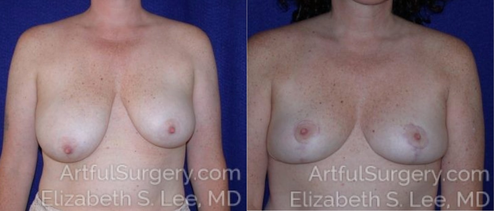 Picture of Breast Lift-2a