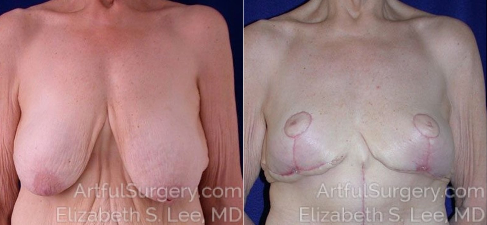 Picture of Breast Lift-3