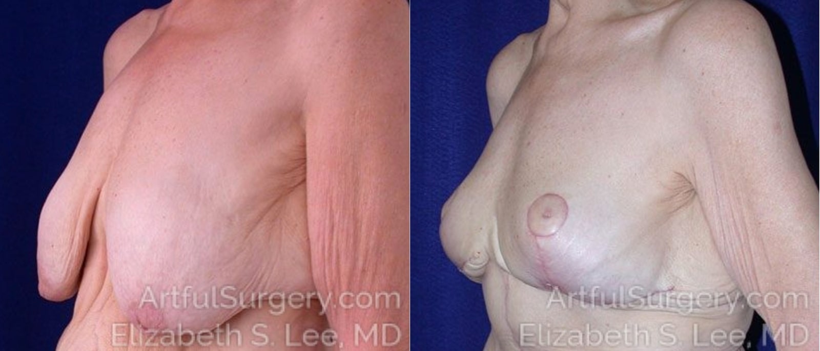 Picture of Breast Lift-3a