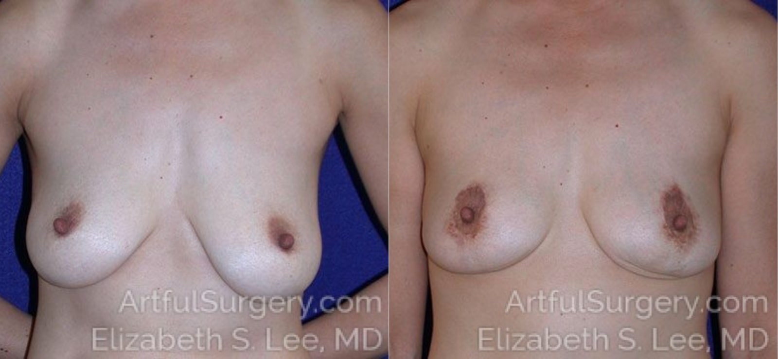 Picture of Breast Lift-4