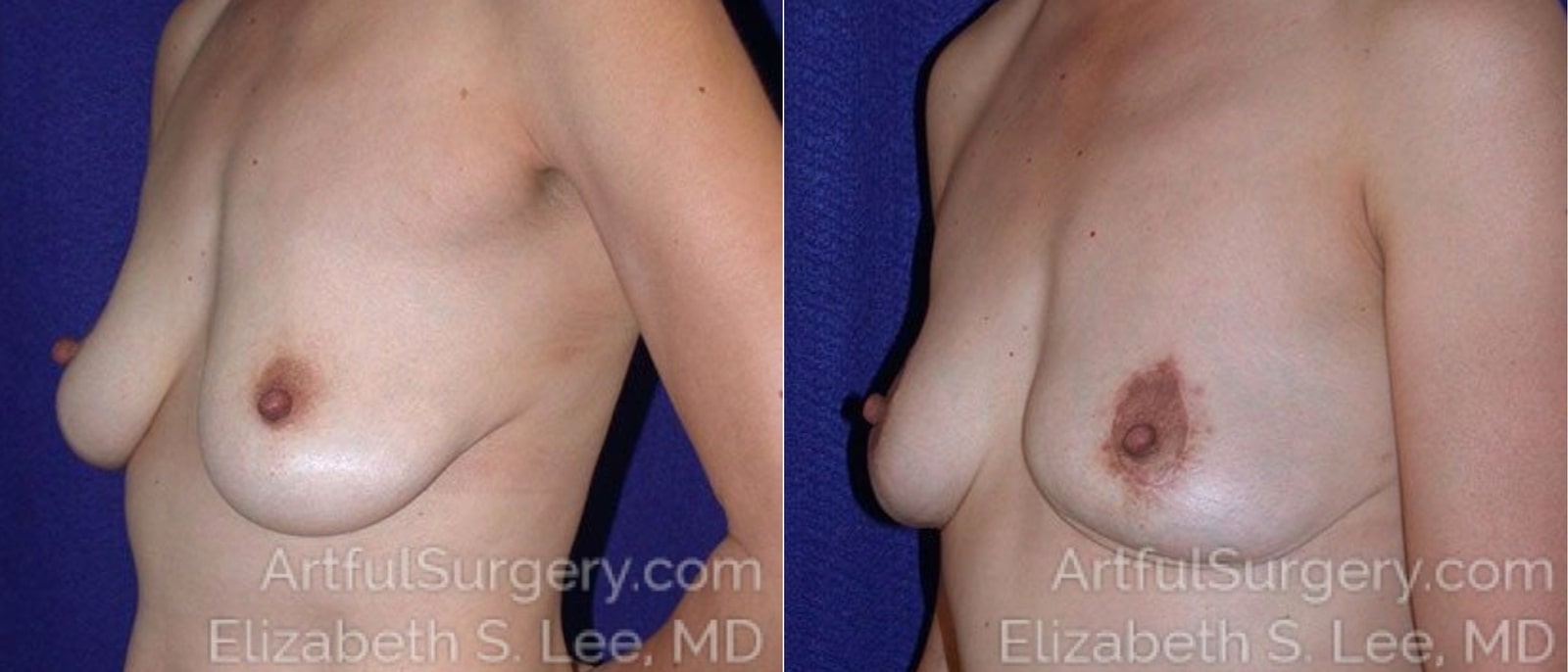 Picture of Breast Lift-4a