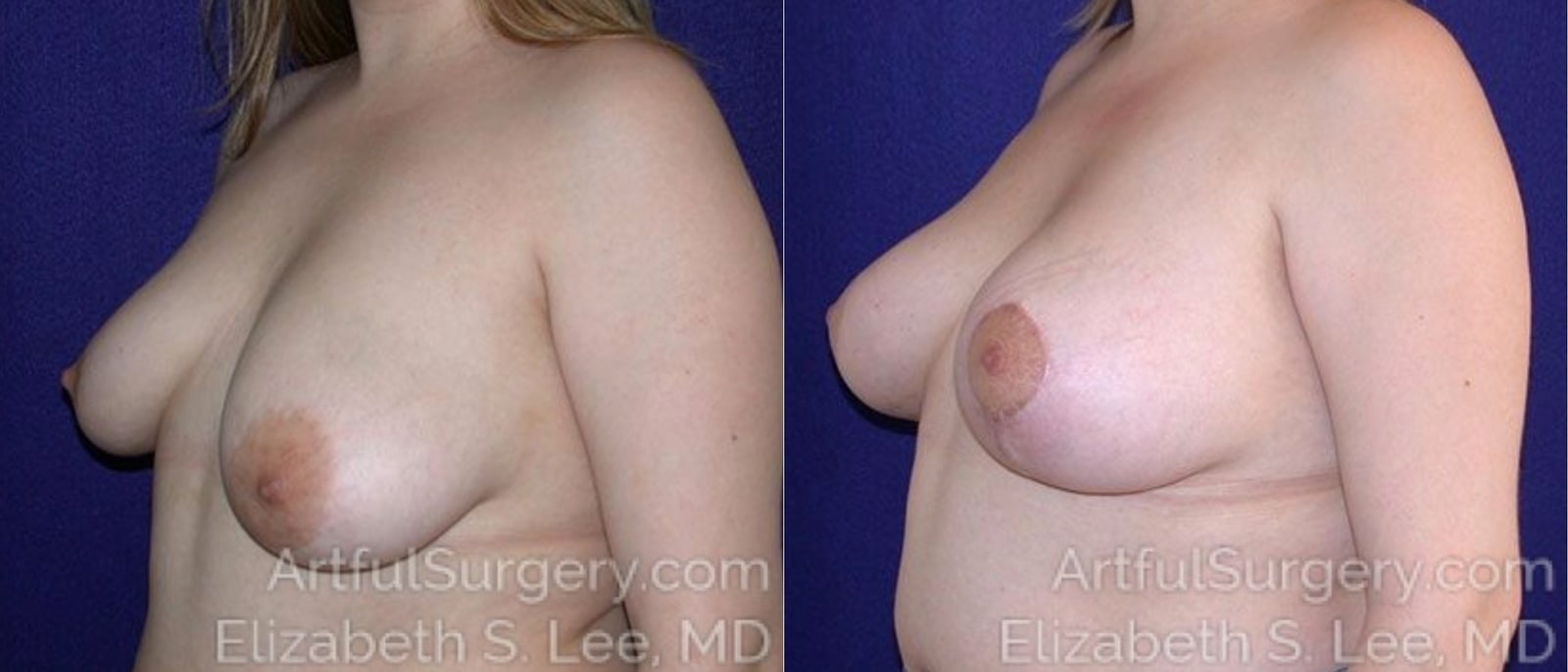 Picture of Breast Lift-5a