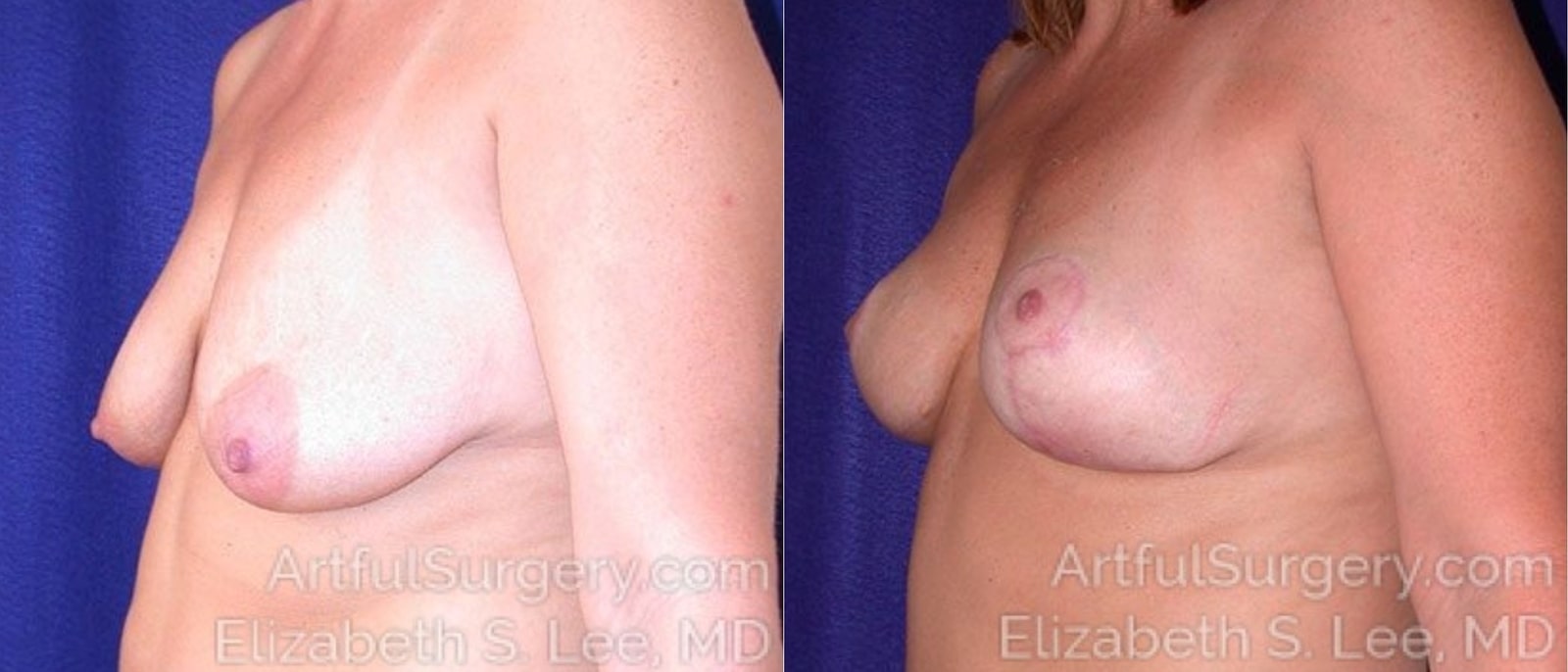 Picture of Breast Lift-6a