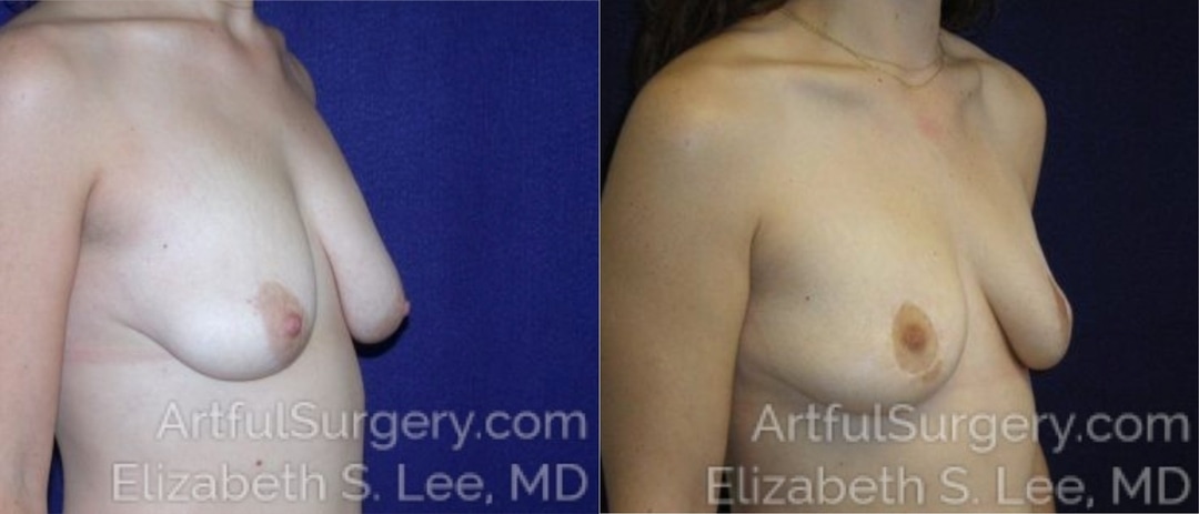 Picture of Breast Lift-7a