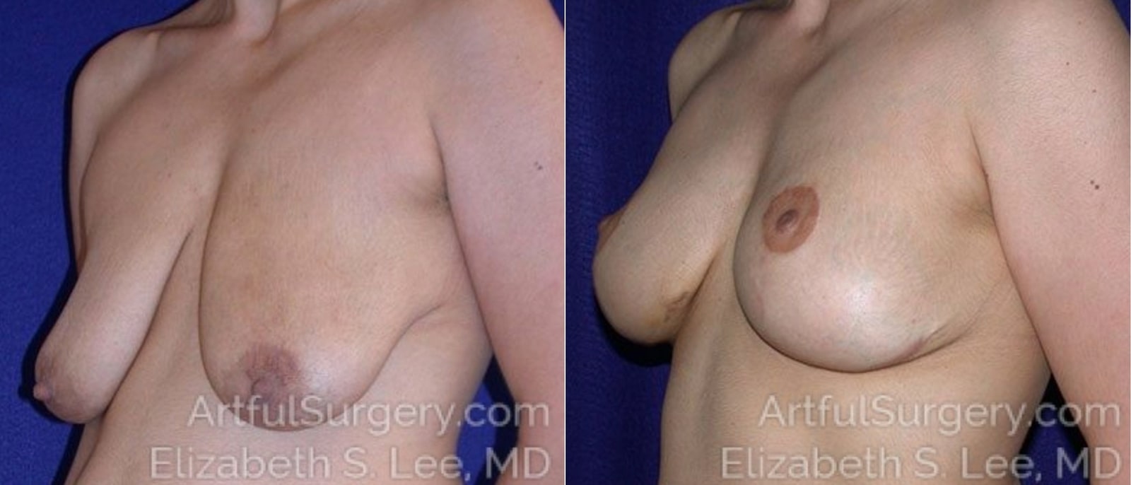 Picture of Breast Lift-8a