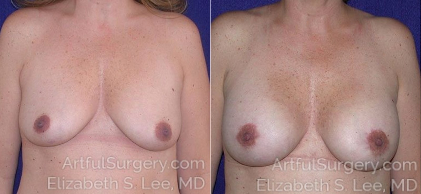 Picture of Breast Lift-9
