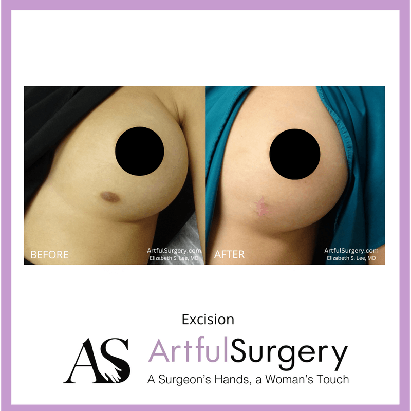 Picture of Breast Reduction-1