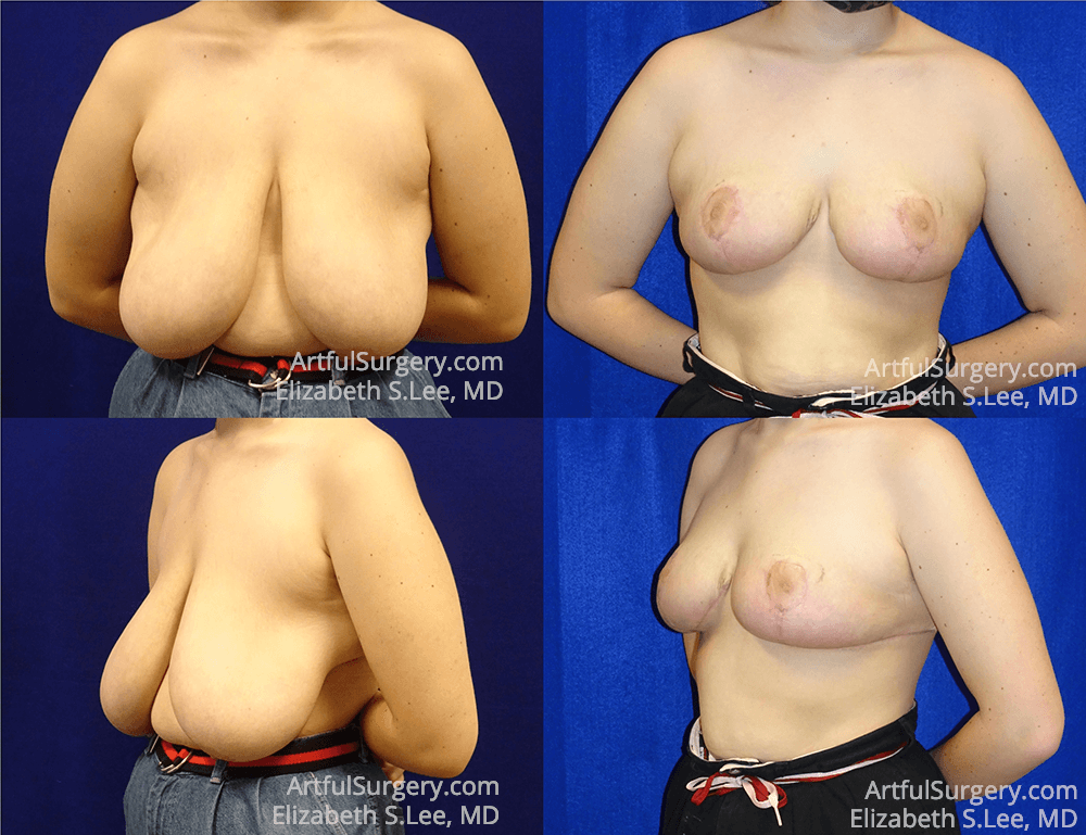 Picture of Breast Reduction-10