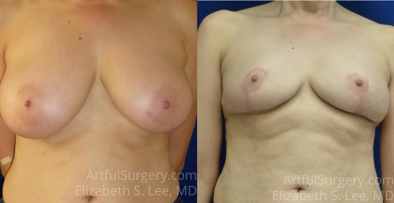 Picture of Breast Reduction-11