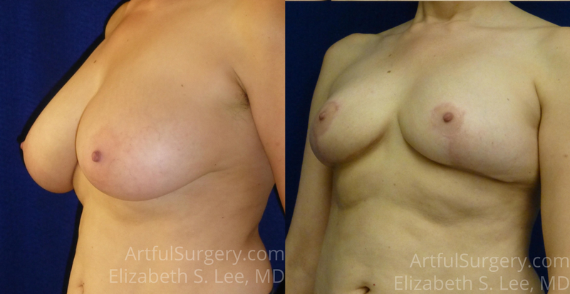 Picture of Breast Reduction-11a
