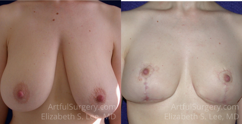 Picture of Breast Reduction-12