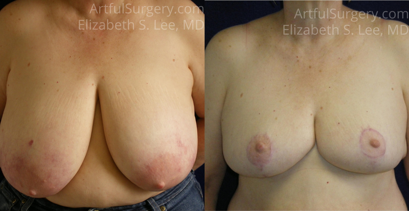 Picture of Breast Reduction-13