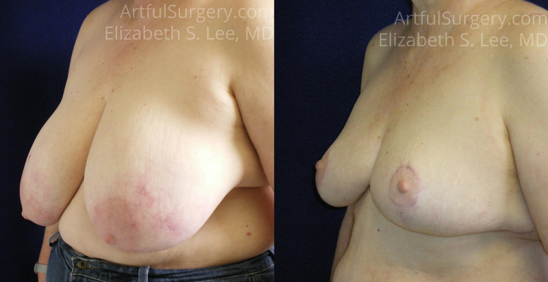 Picture of Breast Reduction-13a