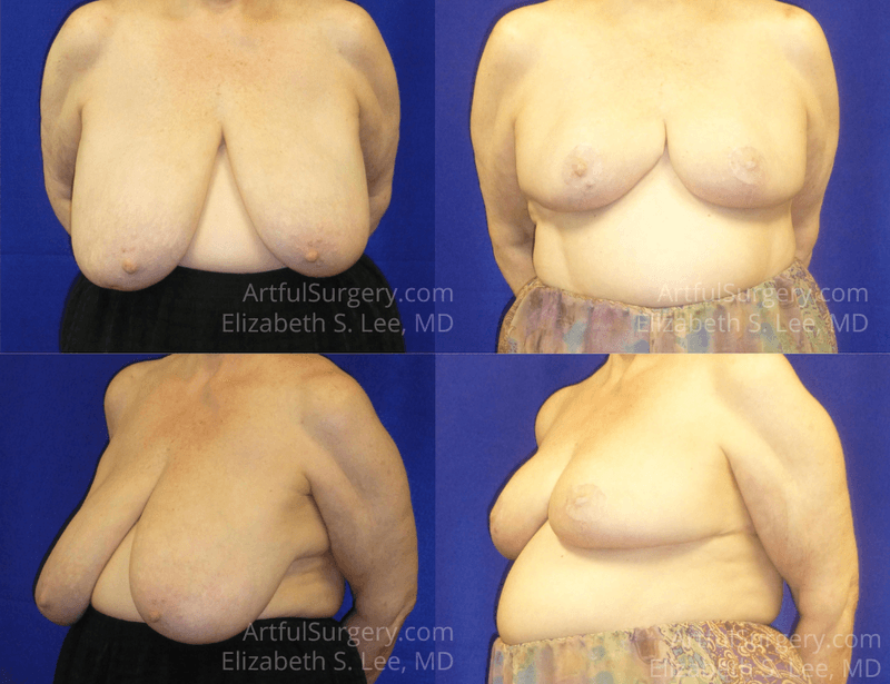 Picture of Breast Reduction-14