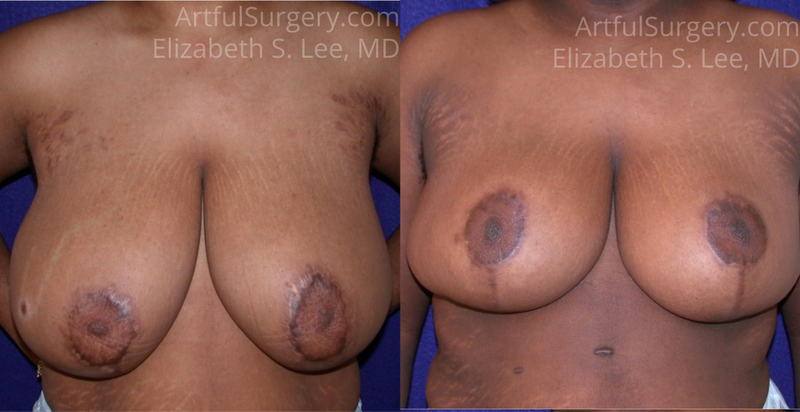 Picture of Breast Reduction-15