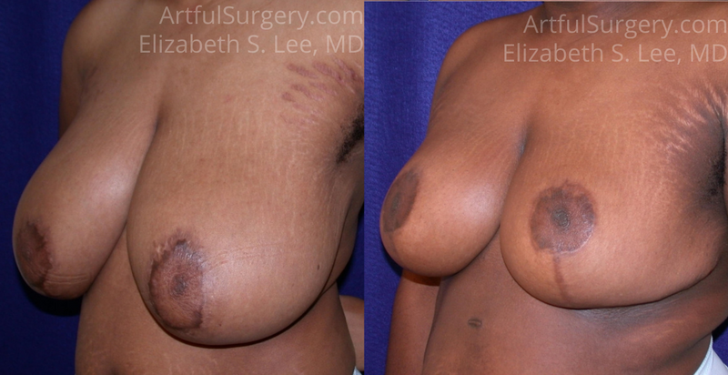 Picture of Breast Reduction-15