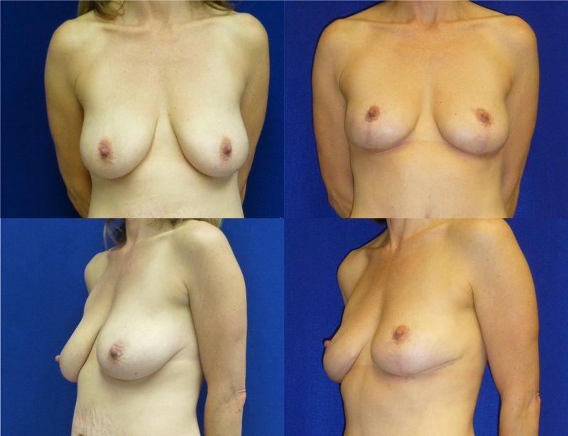 Picture of Breast Reduction-17