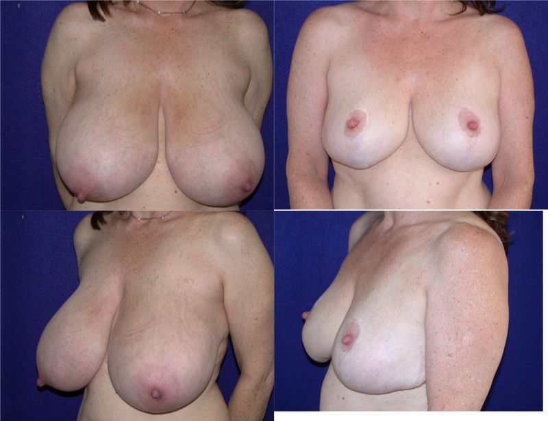 Picture of Breast Reduction-18