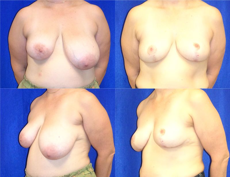 Picture of Breast Reduction-19