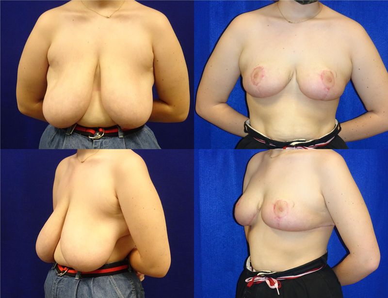 Picture of Breast Reduction-2