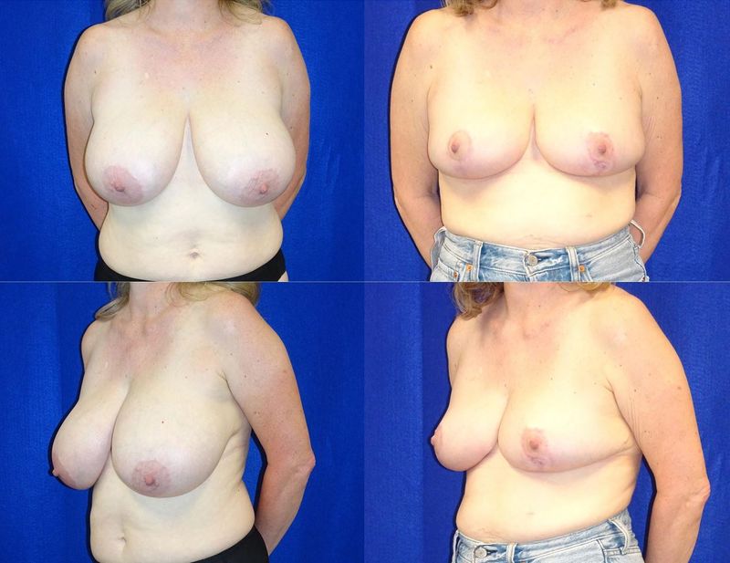 Picture of Breast Reduction-21