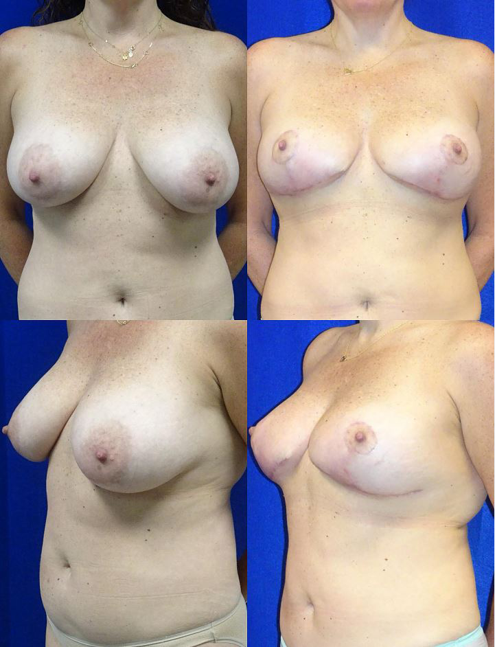Picture of Breast Reduction-22