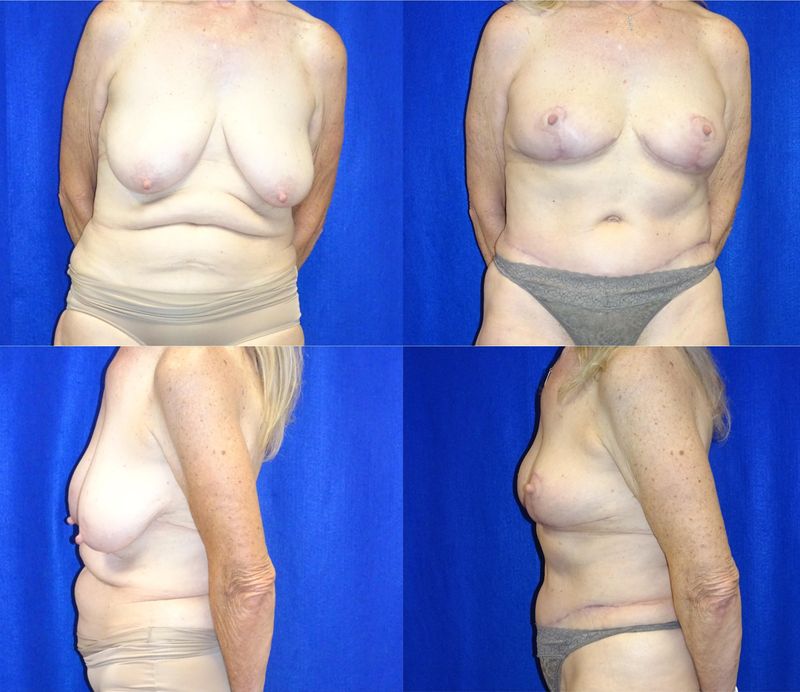 Picture of Breast Reduction-24