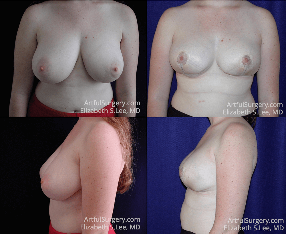 Picture of Breast Reduction-3