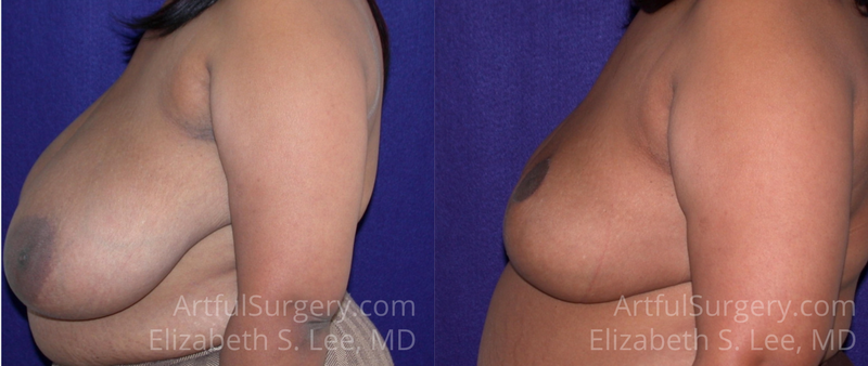 Picture of Breast Reduction-4