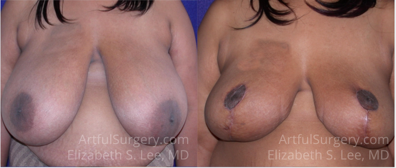 Picture of Breast Reduction-4a